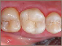 CEREC Tooth Restorations After