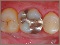 CEREC Tooth Restorations Before