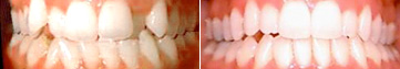 Overly Crowded Teeth Before & After