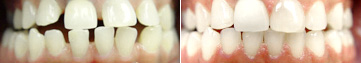 Gapped Teeth Before & After
