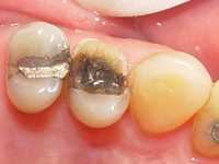 A Tooth with Cracked Tooth Syndrome