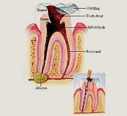 Root Canal Diagram