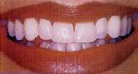 Teeth Whitening After